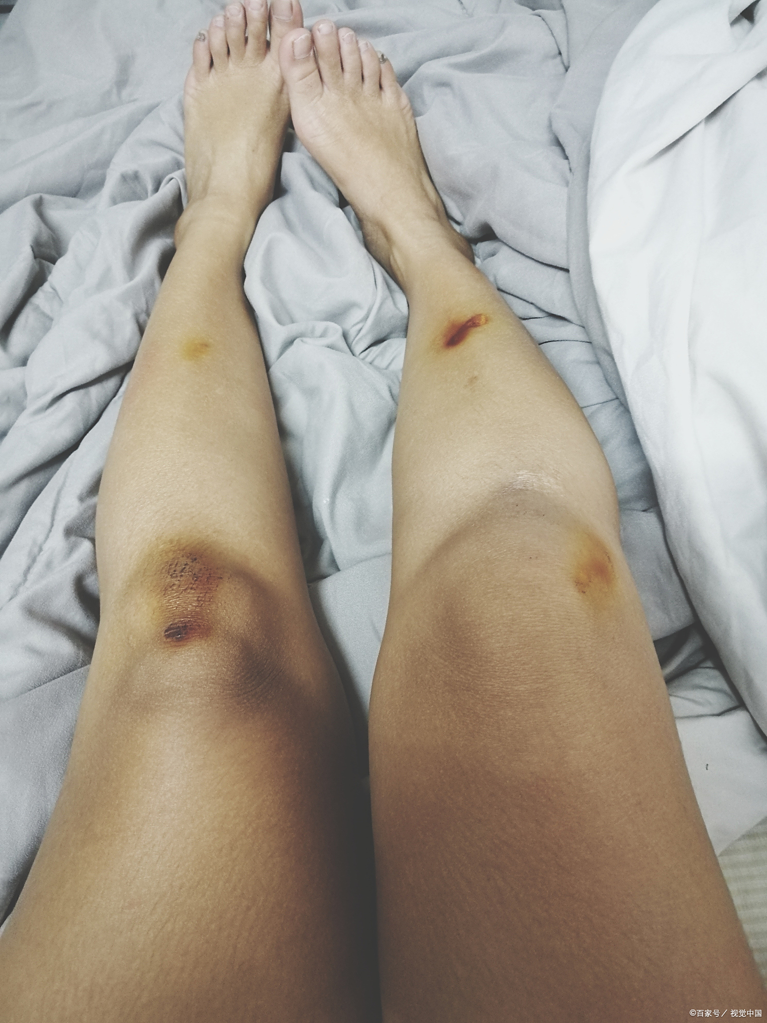 小腿有淤血,一按有点疼,怎么办?