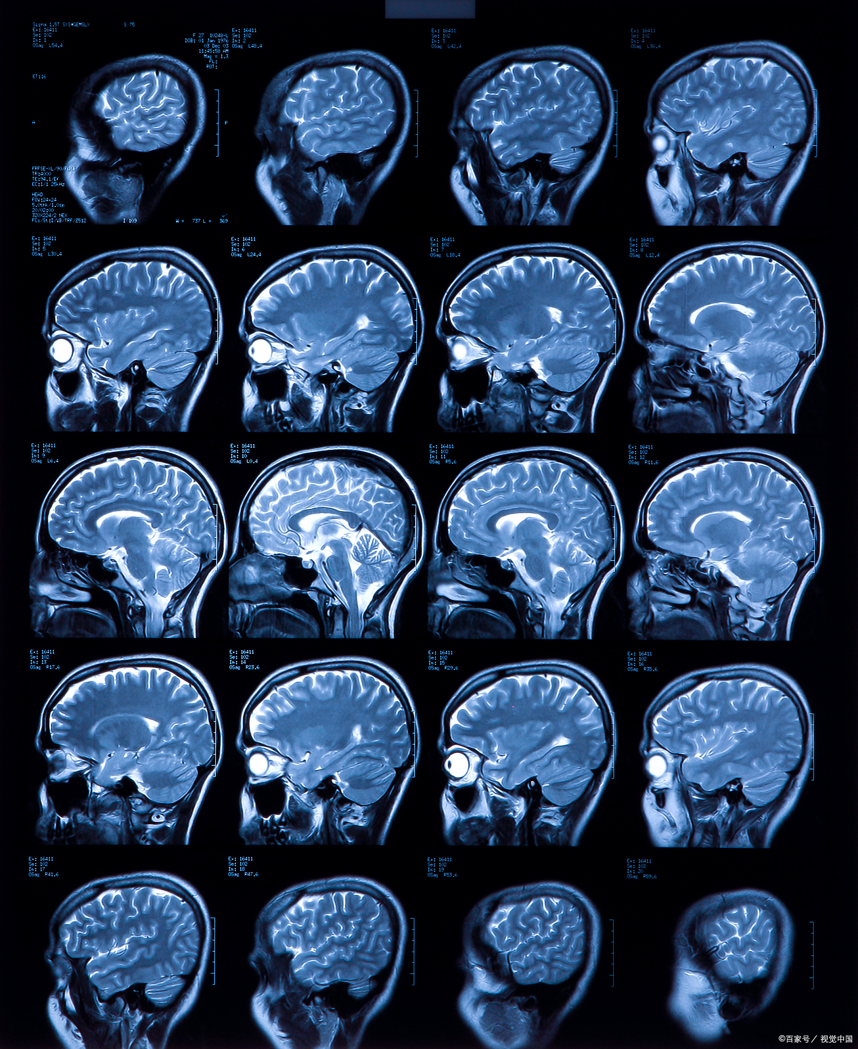 脑膜瘤是起源于脑膜组织的肿瘤,在人群中较为常见