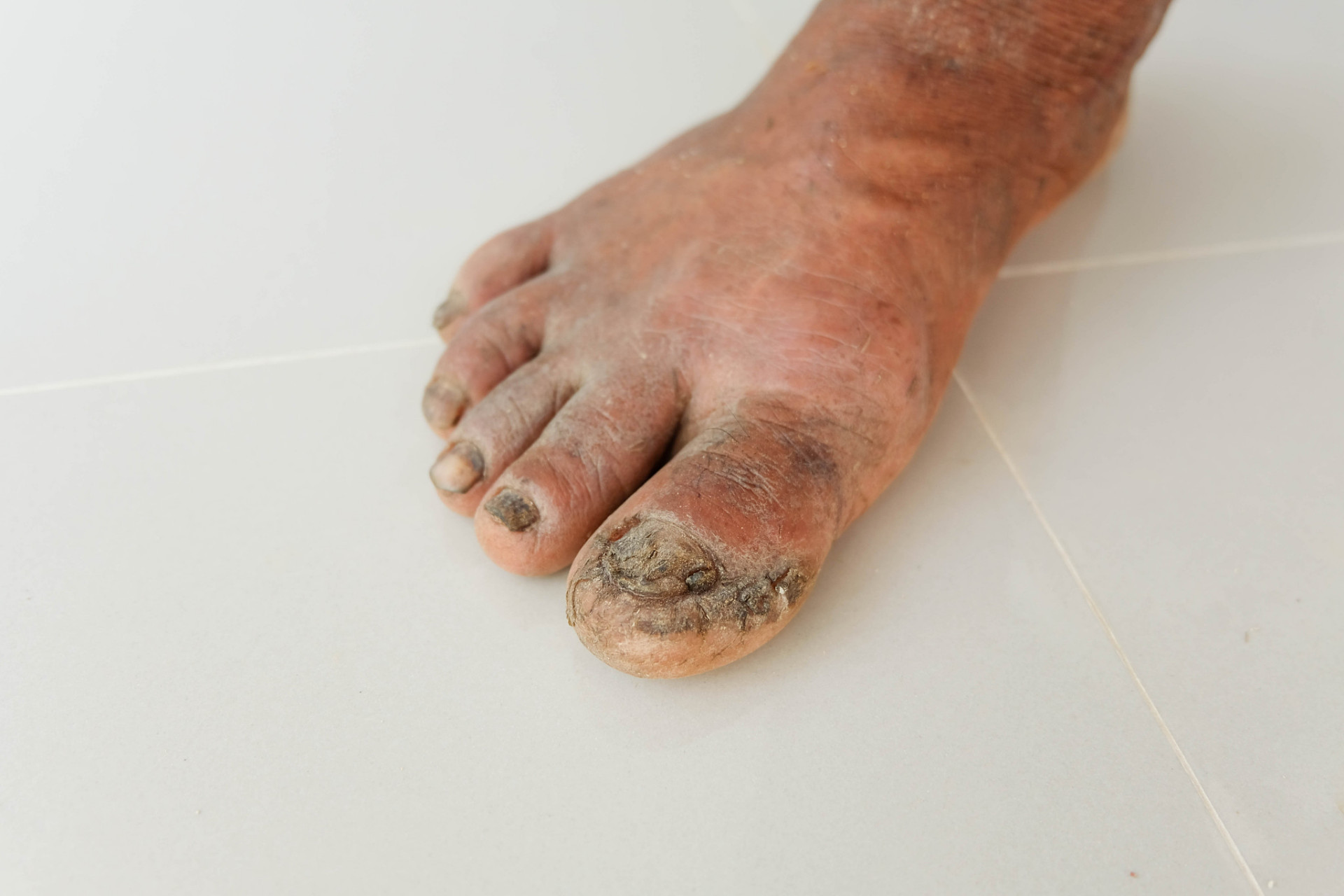 作为糖尿病患者,应该注意哪些事项来预防糖尿病足的发生呢?