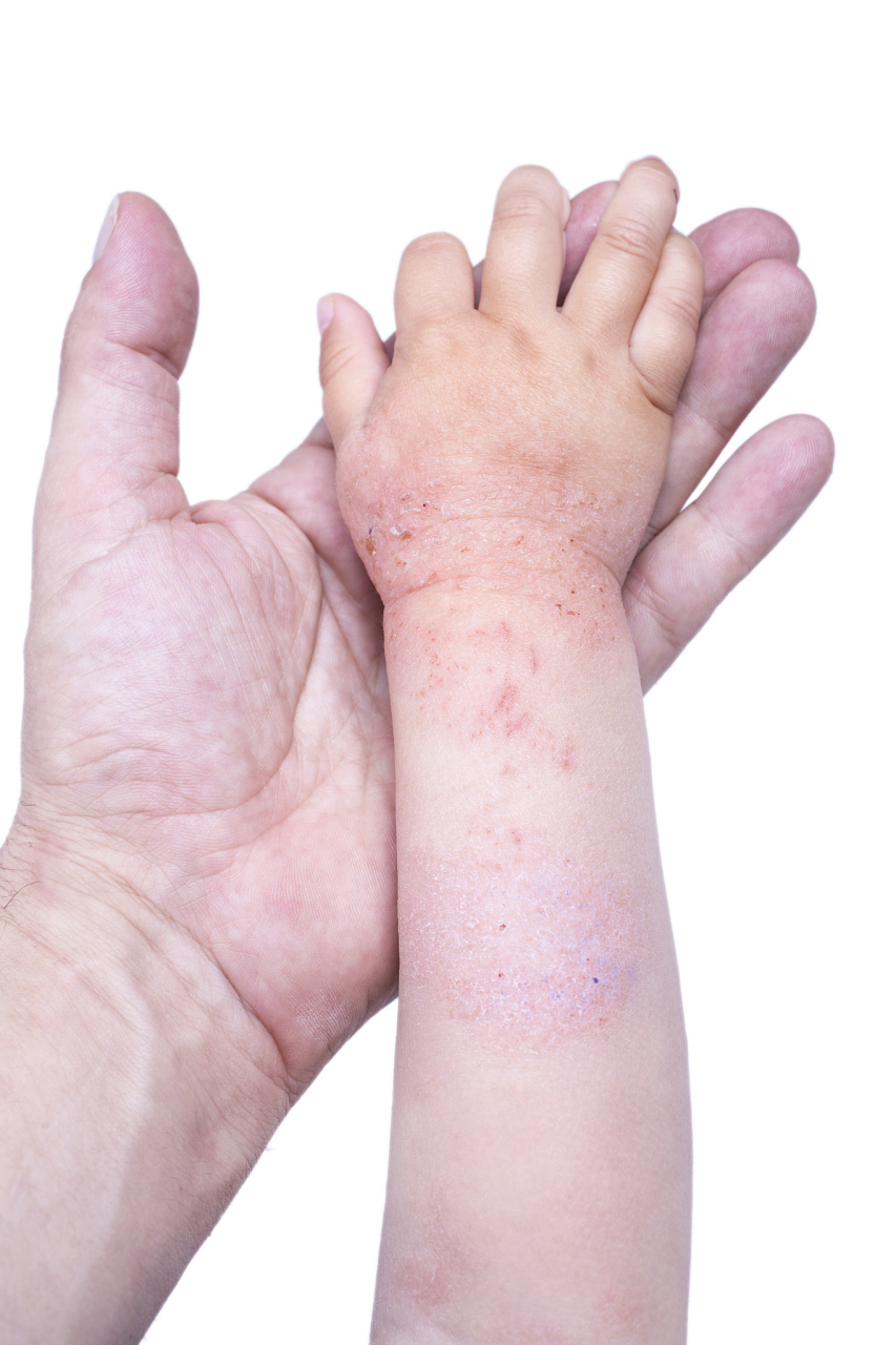 儿童湿疹,也称为婴儿湿疹或特应性皮炎,是一种常见的皮肤病,主要