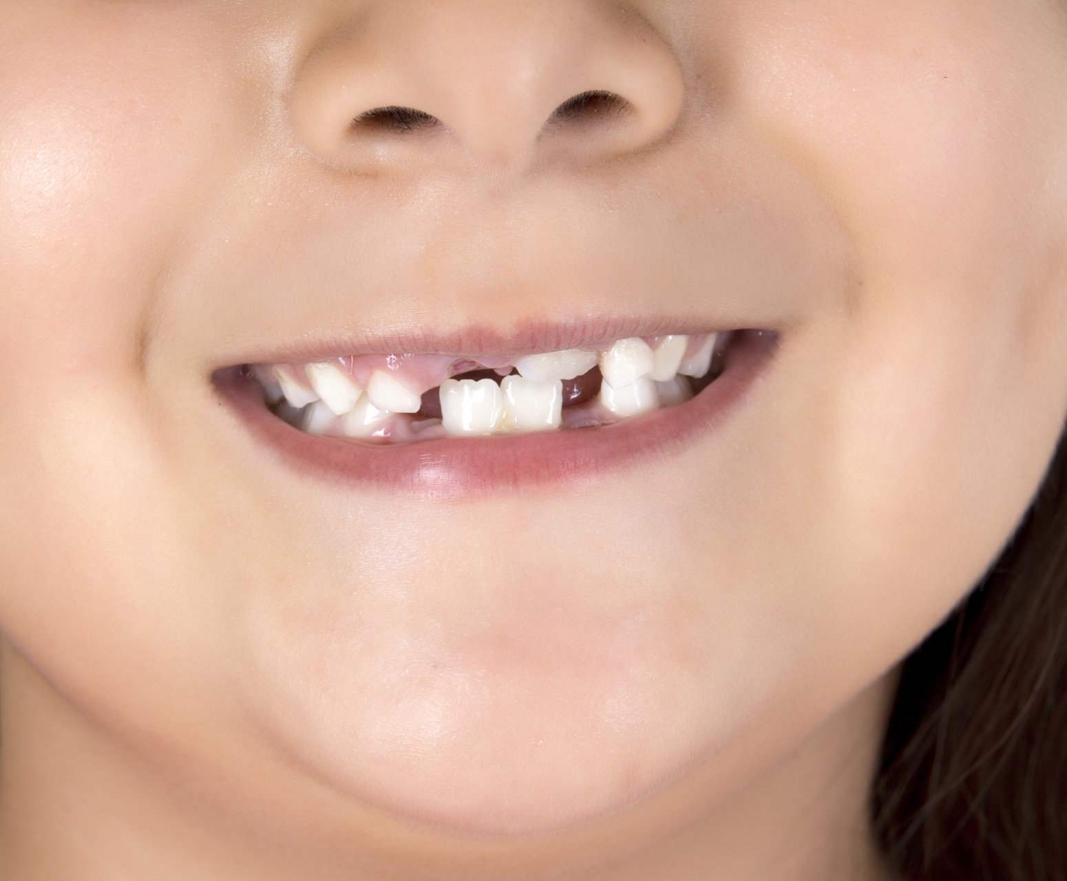 【医生揭秘】儿童牙齿不齐?别担心,这里有妙招!