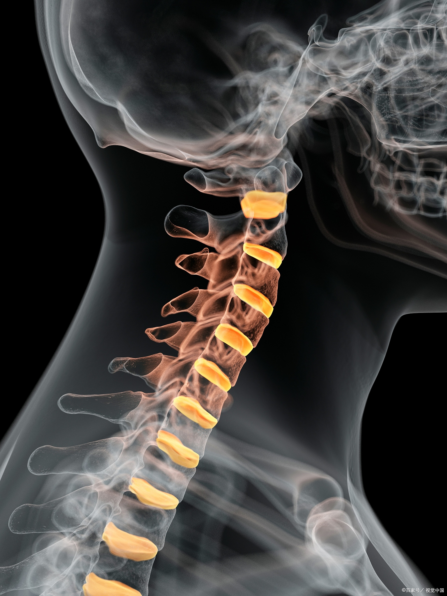 它的形成通常与长期不良姿势,颈椎生理曲度改变,椎体错位,肌肉慢性