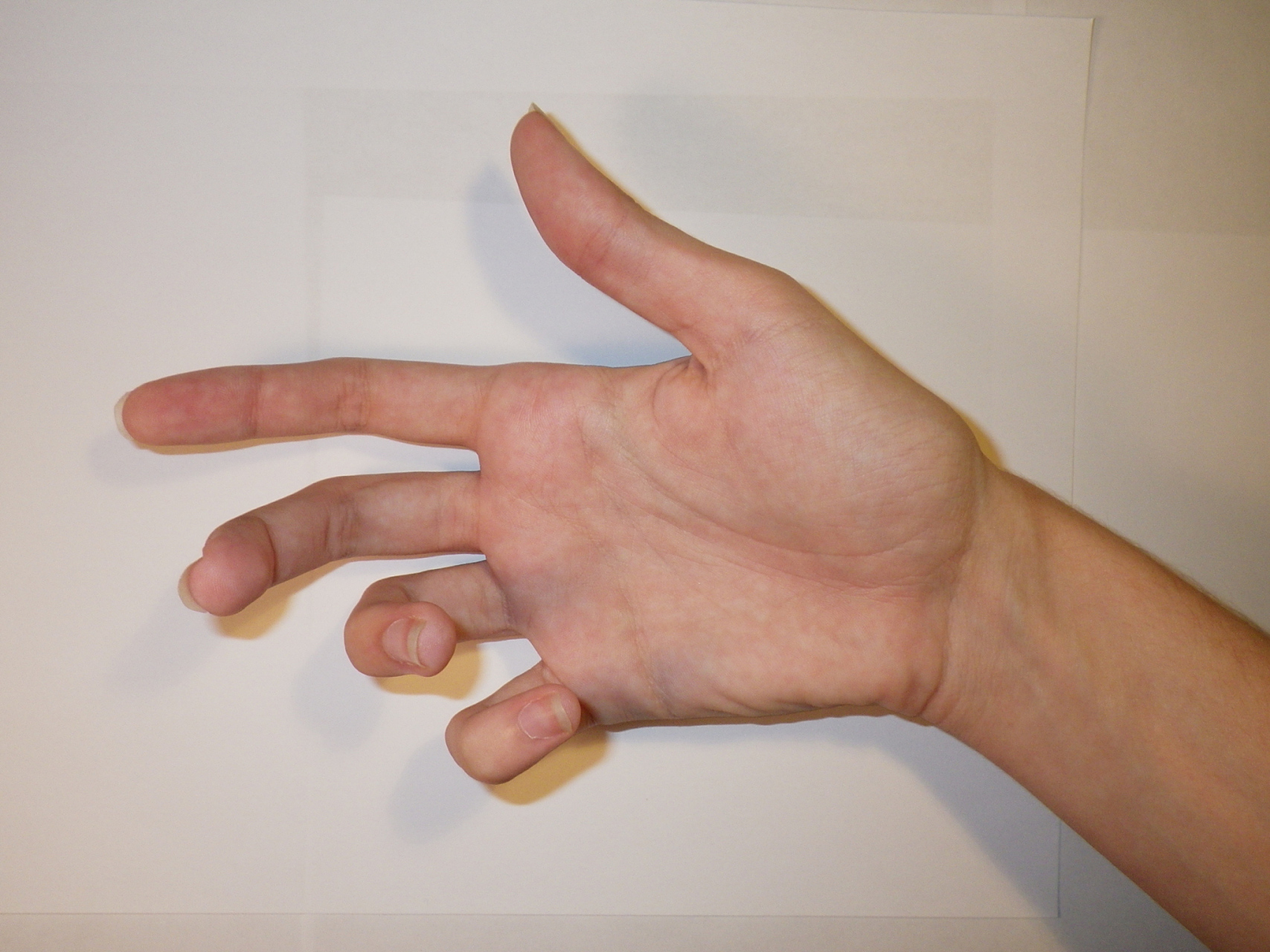 手部神经损伤:爪形手,猿手,垂腕 桡神经:主要支配虎口背侧皮肤妇貂