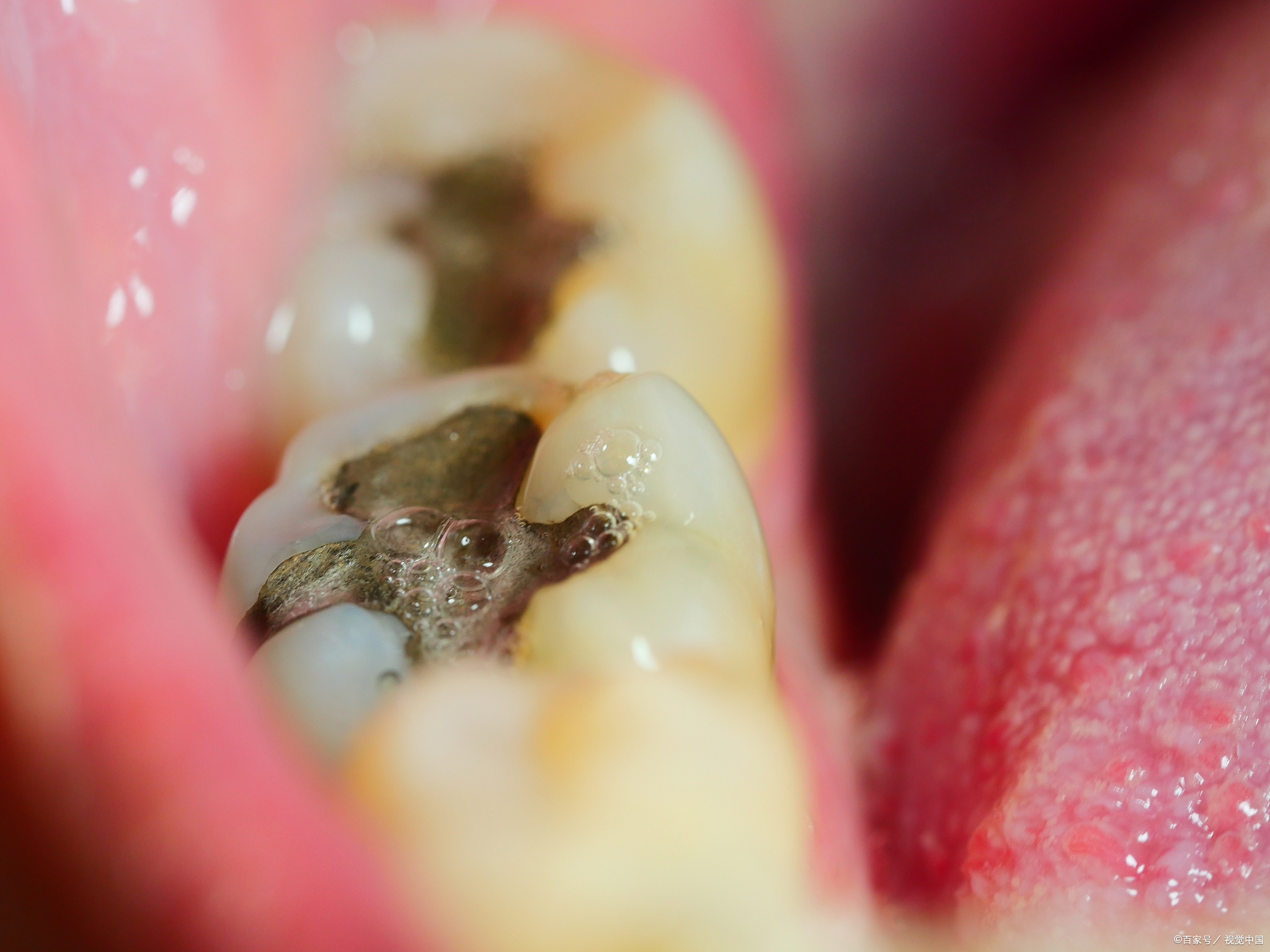 智齿,这个让人又爱又恨的"小东西",一旦在我们的口腔中崭露头角,总