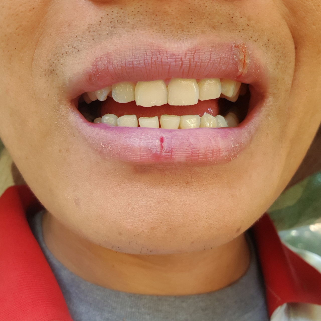 每周创作进行时8月#  嘴角烂,也被称为口角炎,是一种常见的口腔皮肤