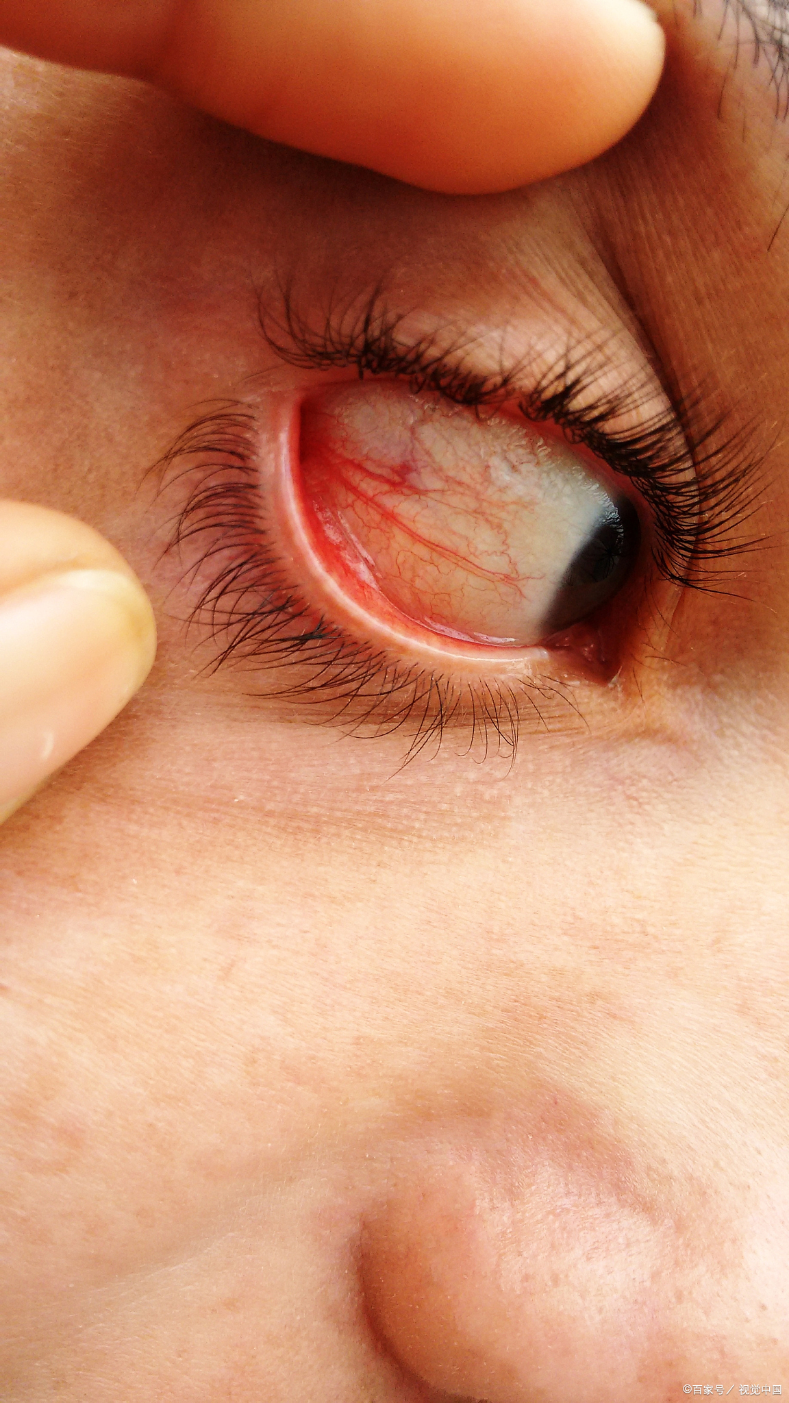 眼睛红得像血常见原因: 一是结膜下出血,多因用力