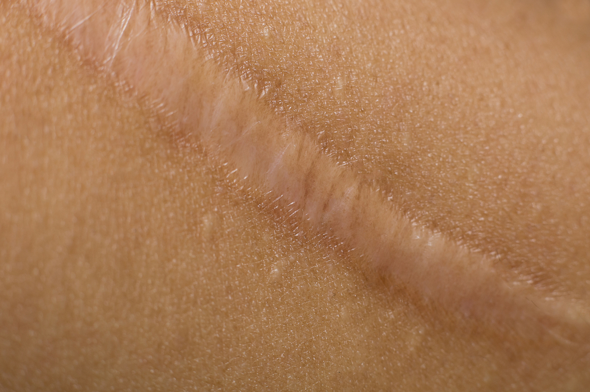 如何判断自己是否是瘢痕体质?