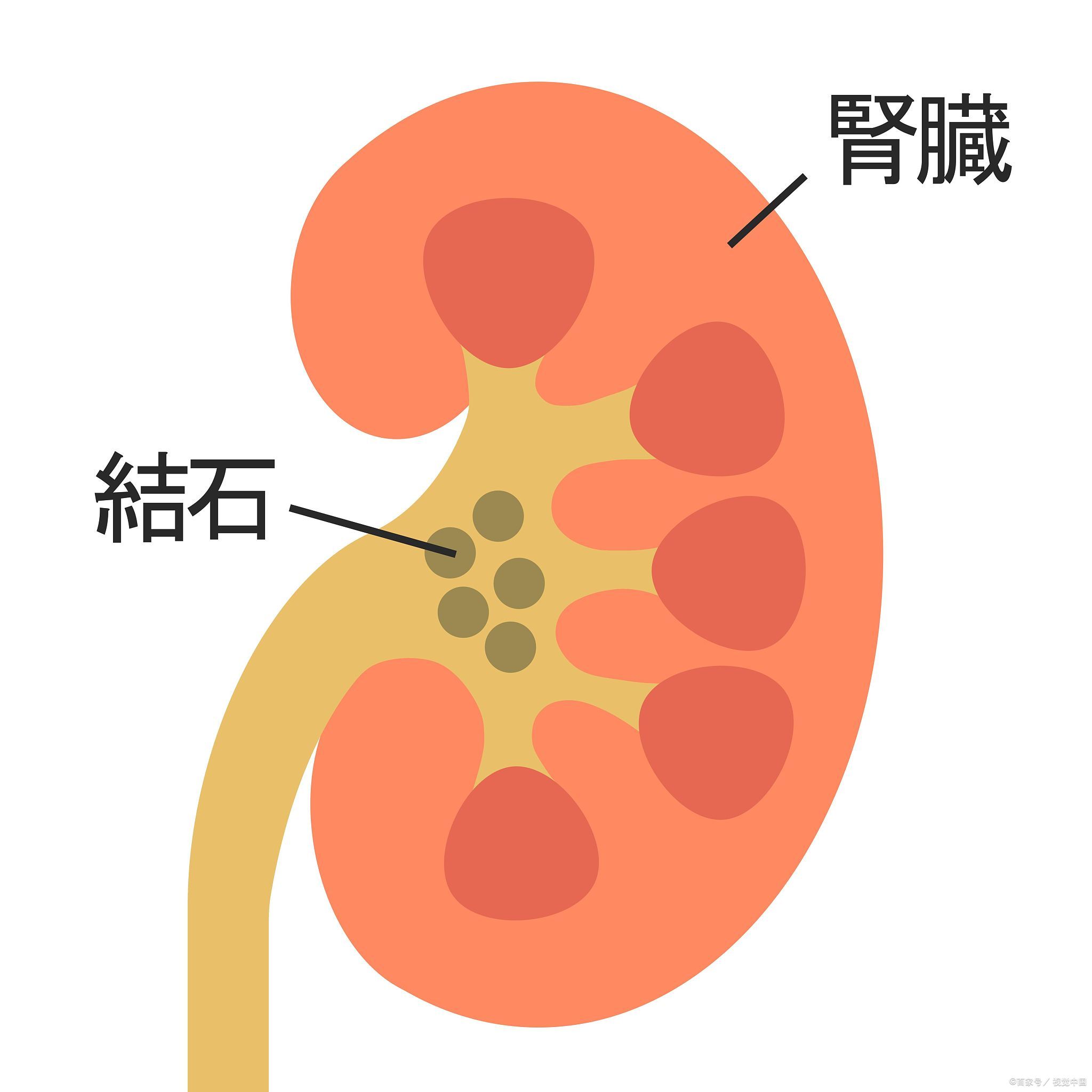 结石排出来的过程图图片