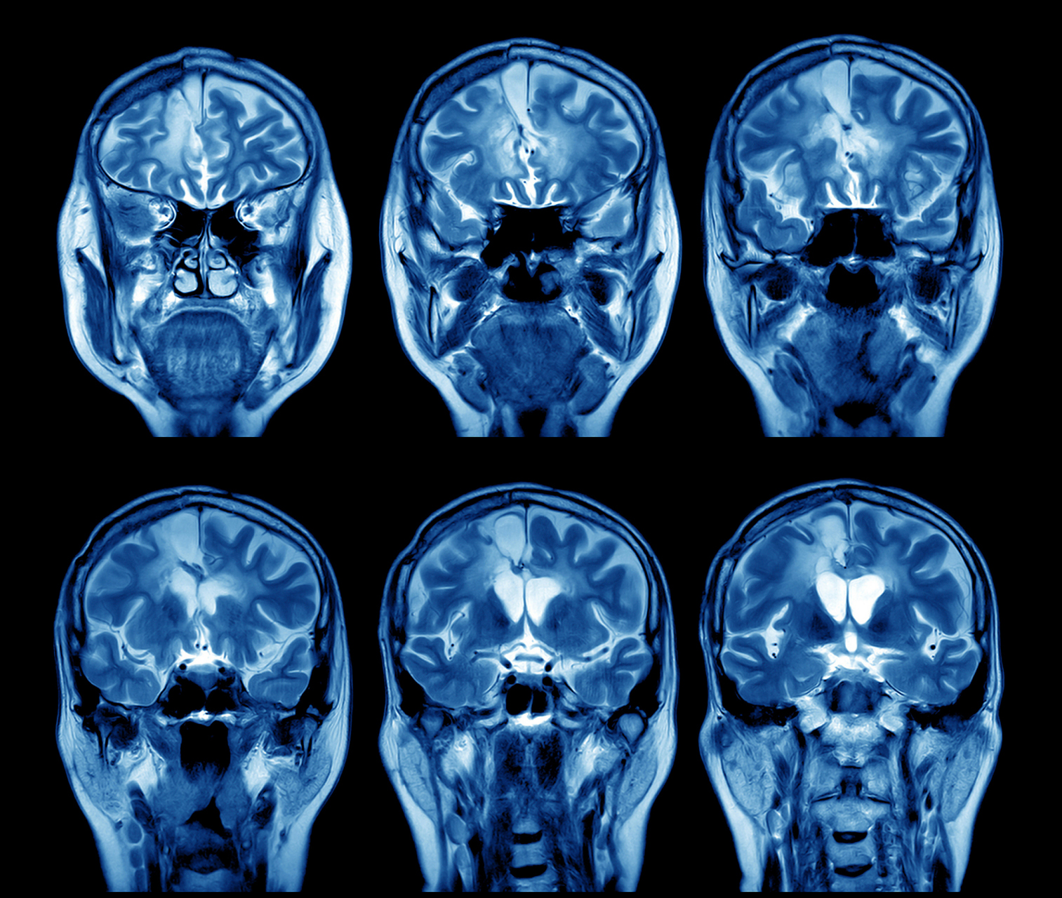 可以通过成像技术观察和记录脑部结构和功能上的变化