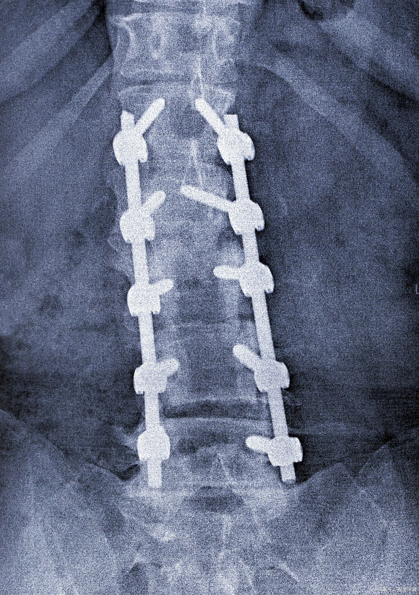 腰椎手术钉子图片钢钉图片