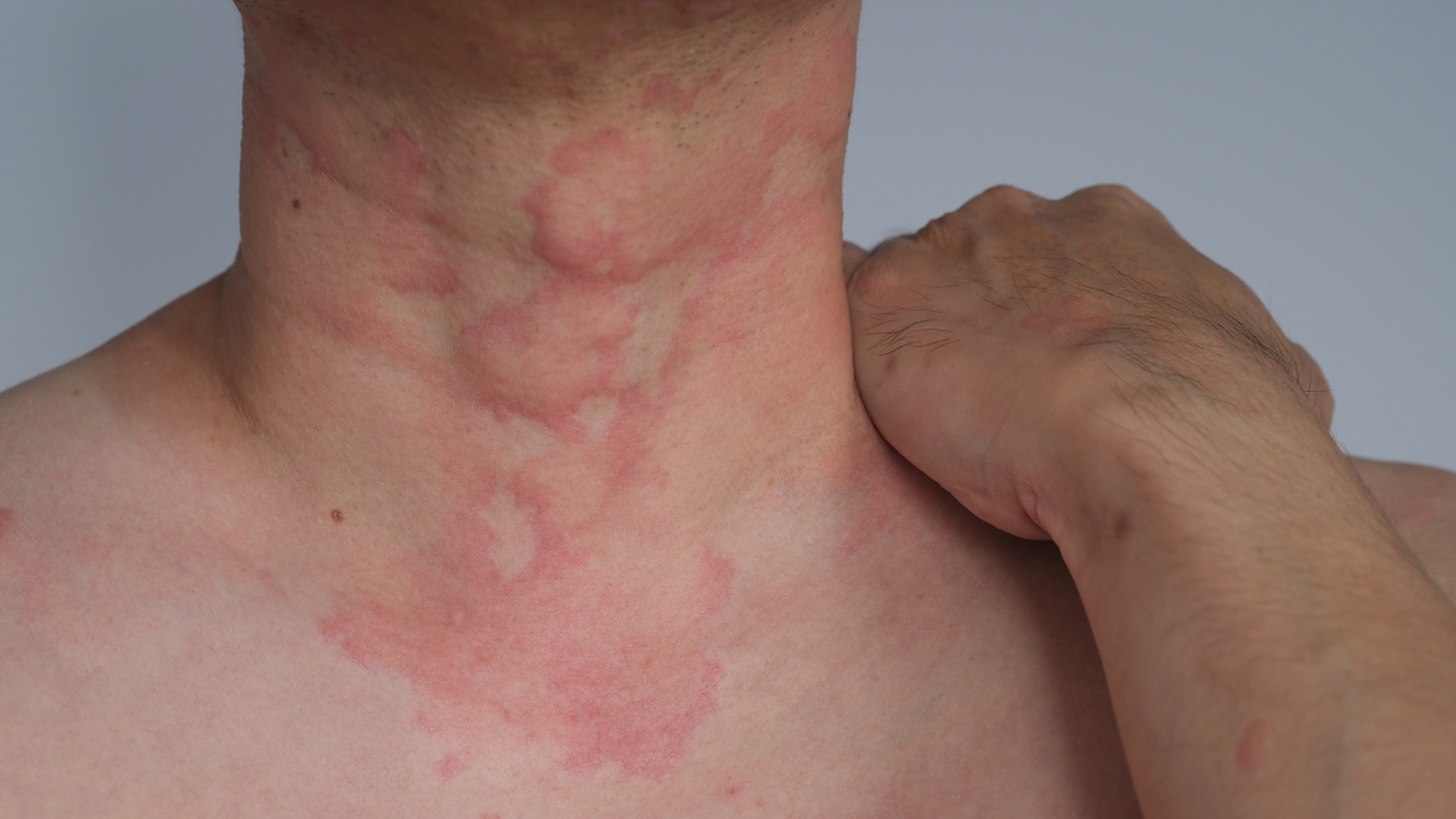 老人们说的"鬼风疙瘩",西医称之为荨麻疹.为什么叫它"鬼风疙瘩"呢?