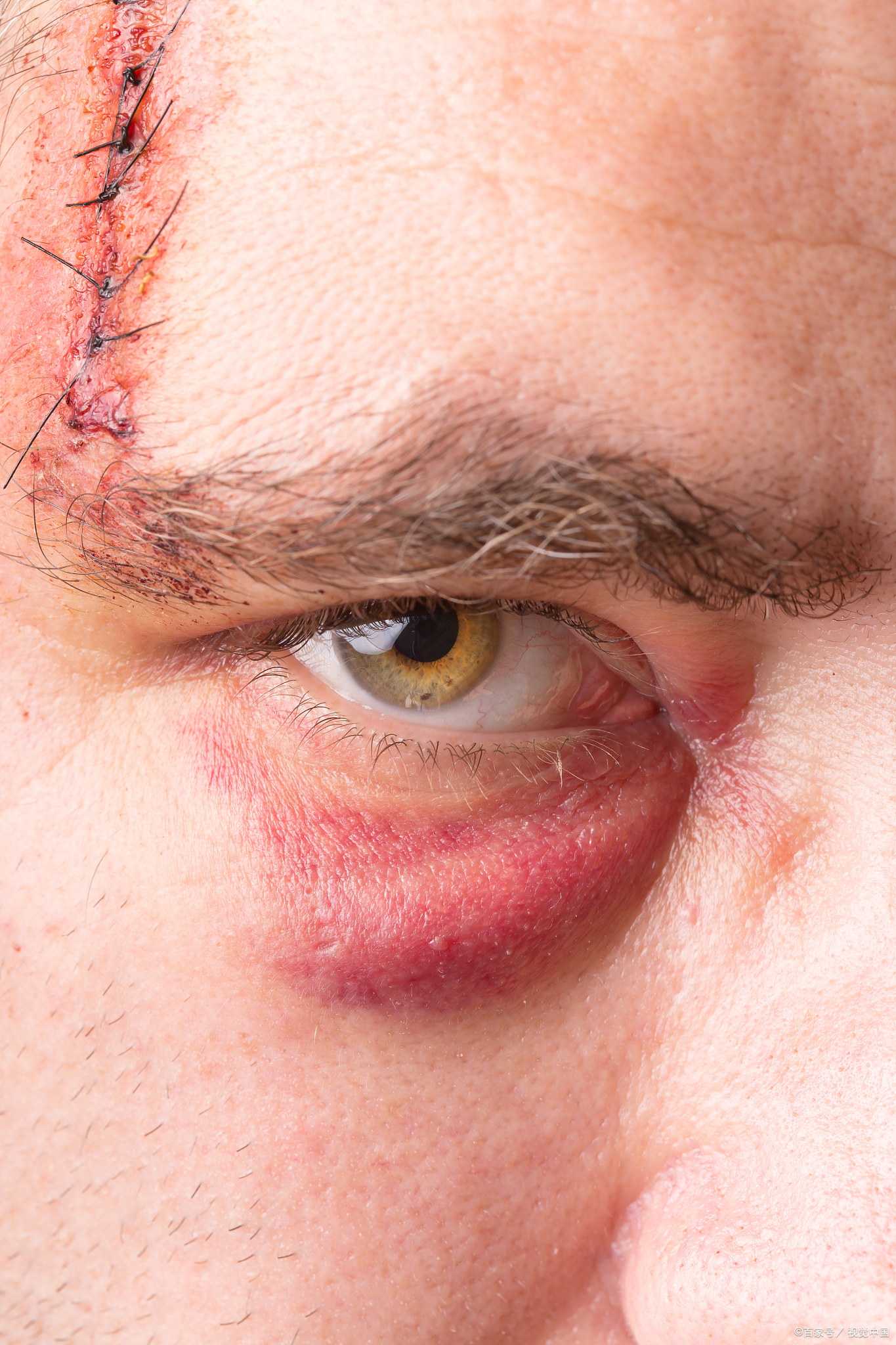 若异物入眼,切勿揉眼,可轻眨眼睛,让泪水冲出异物;若无效,用干净