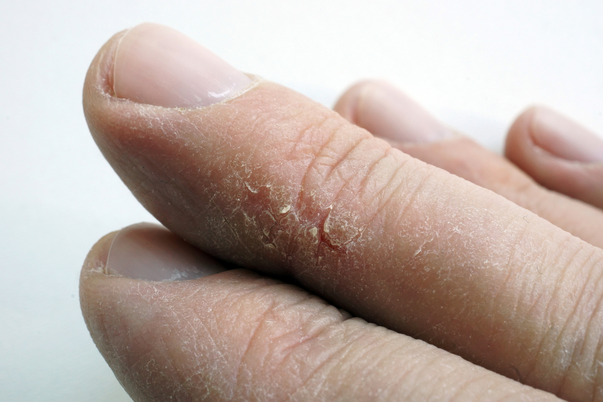 1,汗疱疹:汗疱疹是一种常见的皮肤病,通常表现为手和手指侧面出现