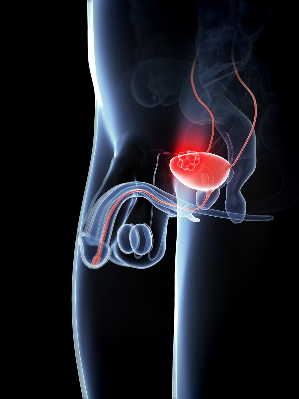 膀胱癌是比较严重的疾病,患有此疾病后会出现膀胱区疼痛,尿频等彩适