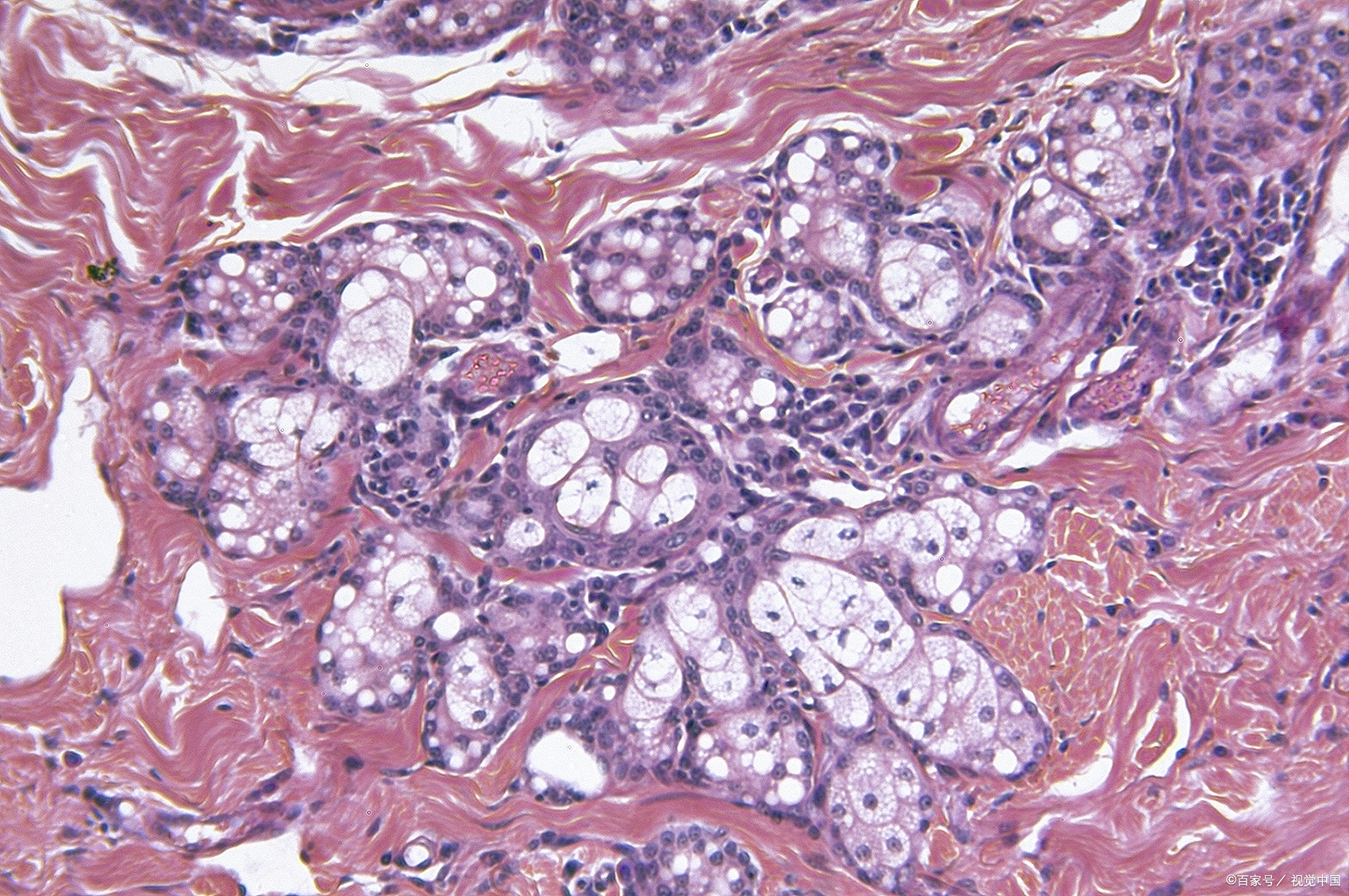 卵巢小细胞癌，肺型