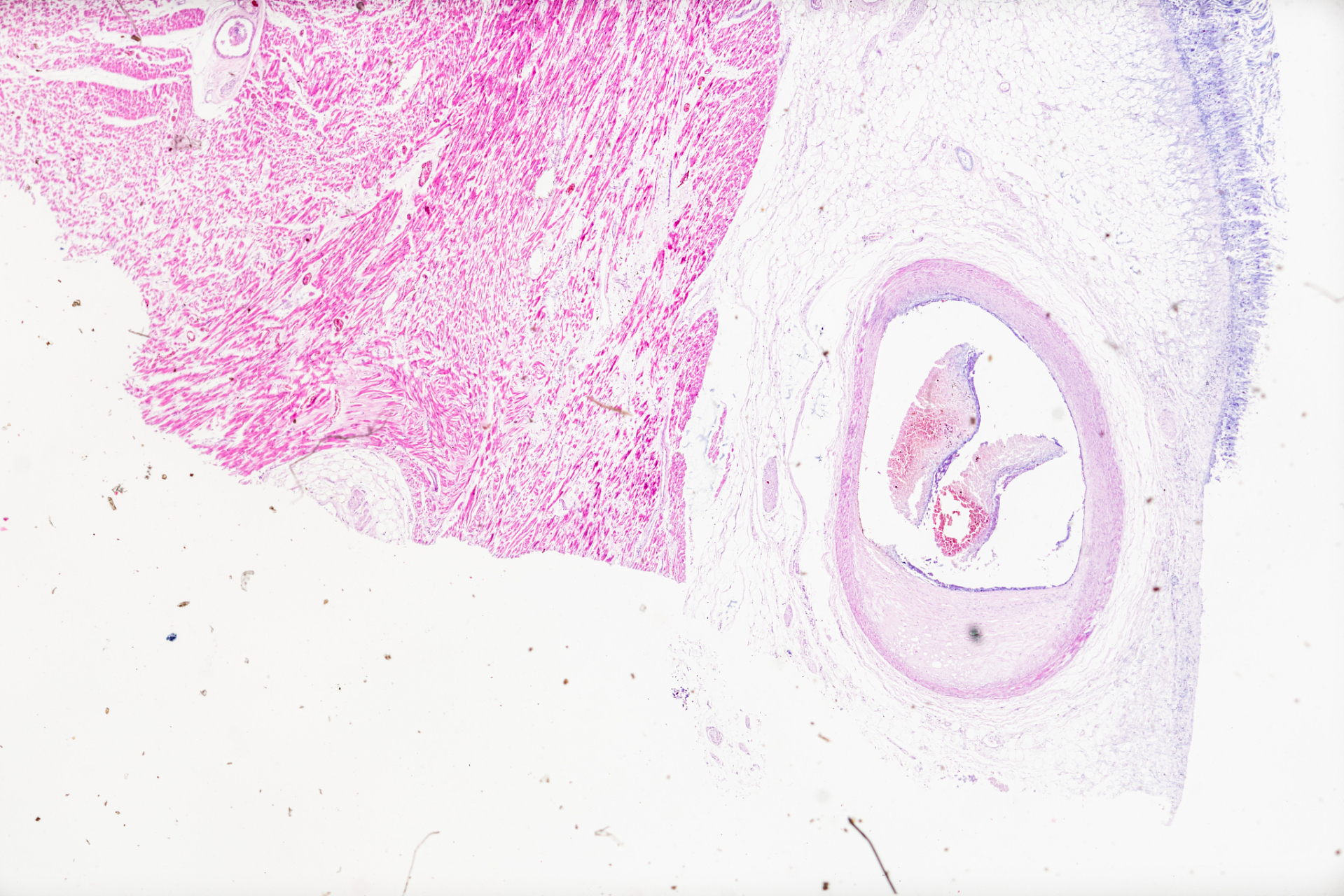 【低压低的原因及治疗】 低压低的原因在临床上见于动脉系统硬化,主