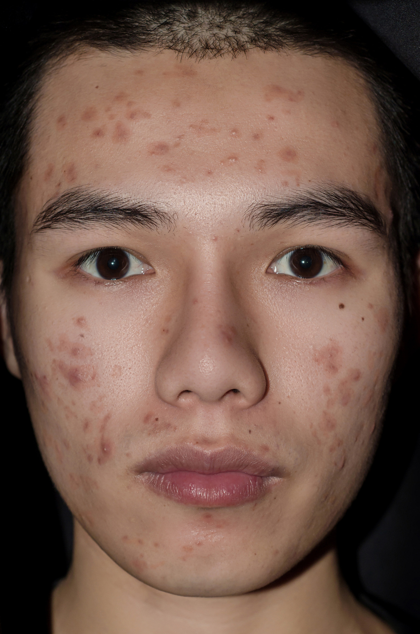 黑痘印一般是指暗色的痘痕或痘疤,通常是痘痘痊愈后在皮肤上留下的