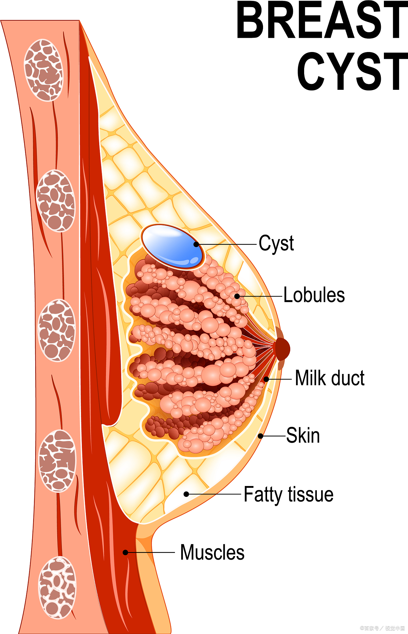 乳腺囊肿是什么?要治疗吗?