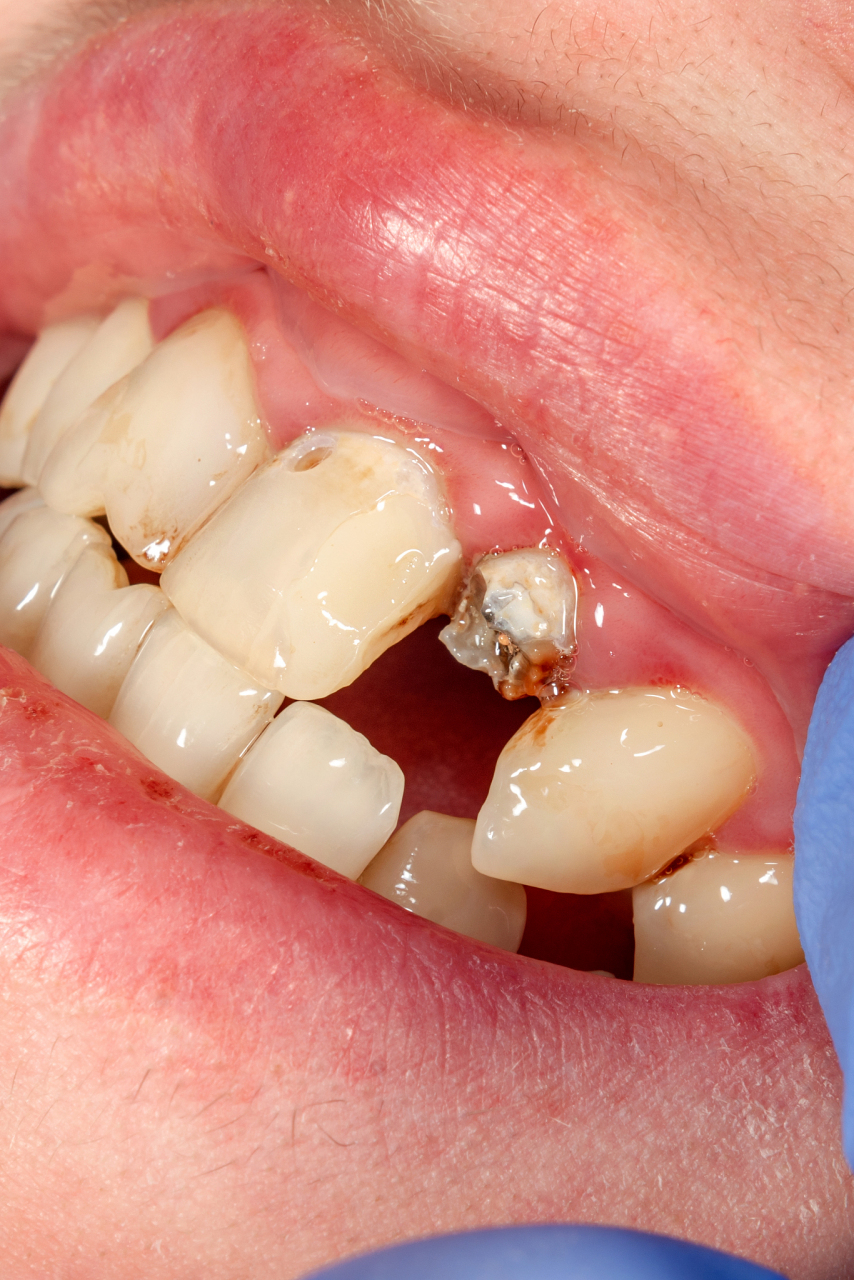 牙齿脆弱易碎可能是由于多种原因造成的,例如牙釉质发育不全,钙化不