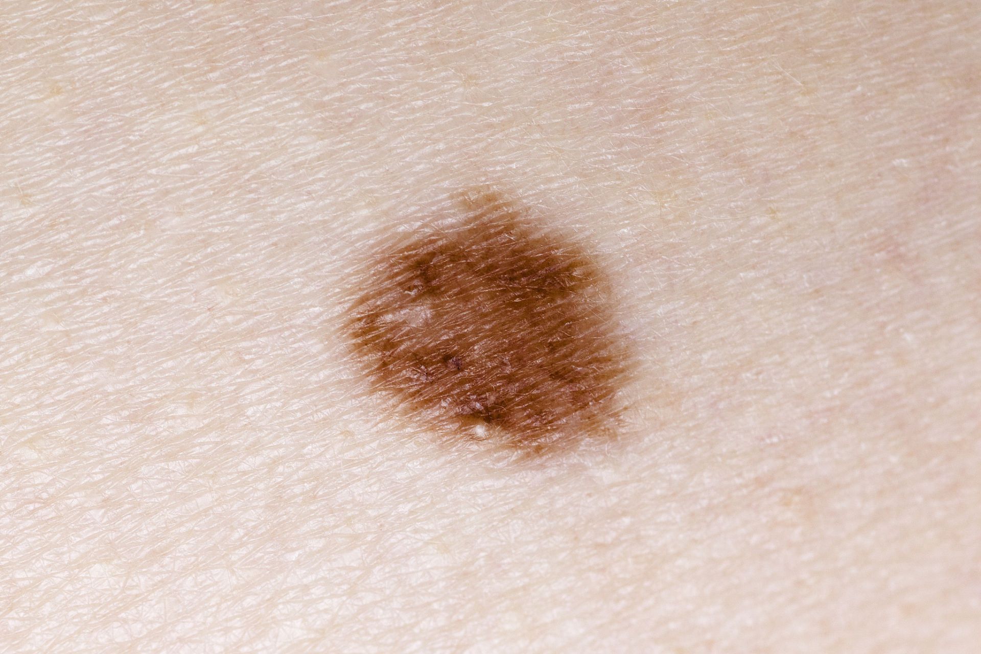 皮内痣激光去除:次数因痣而异  皮内痣激光去除的具体次数,主要取决于