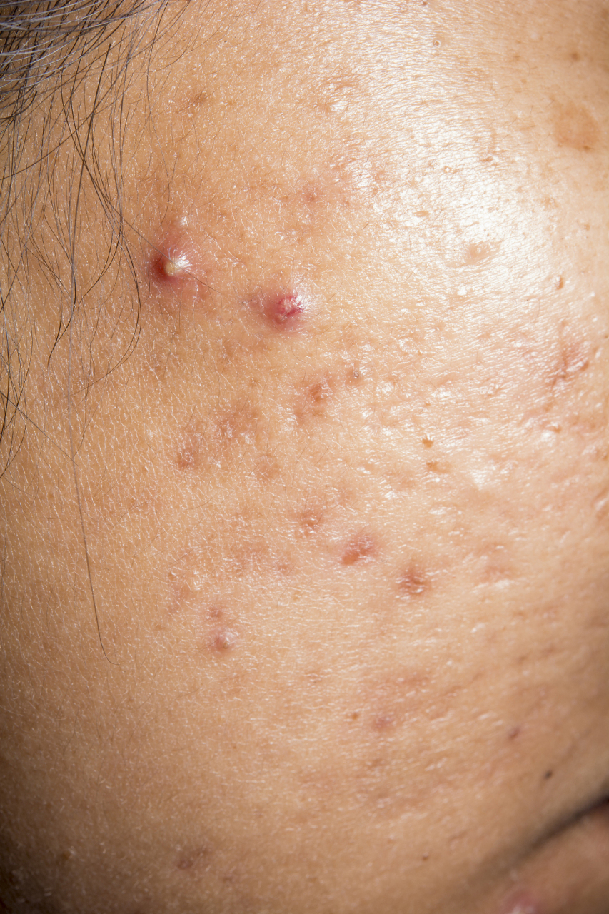 玫瑰痤疮不洗脸反而好了是怎么回事?