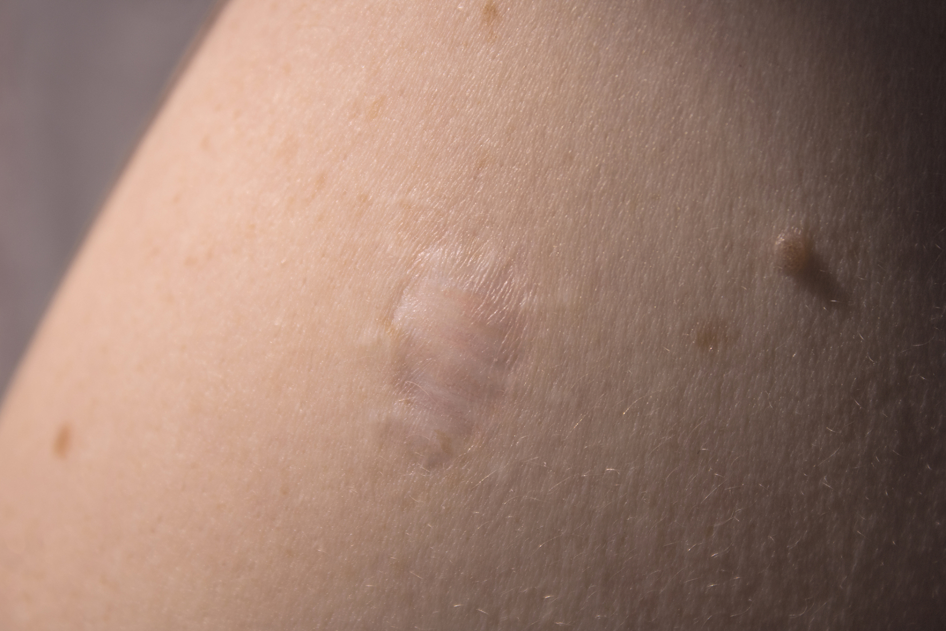 屁股一侧长了个硬疙瘩按着疼怎么办  今天坐诊遇到了患者小李,30岁