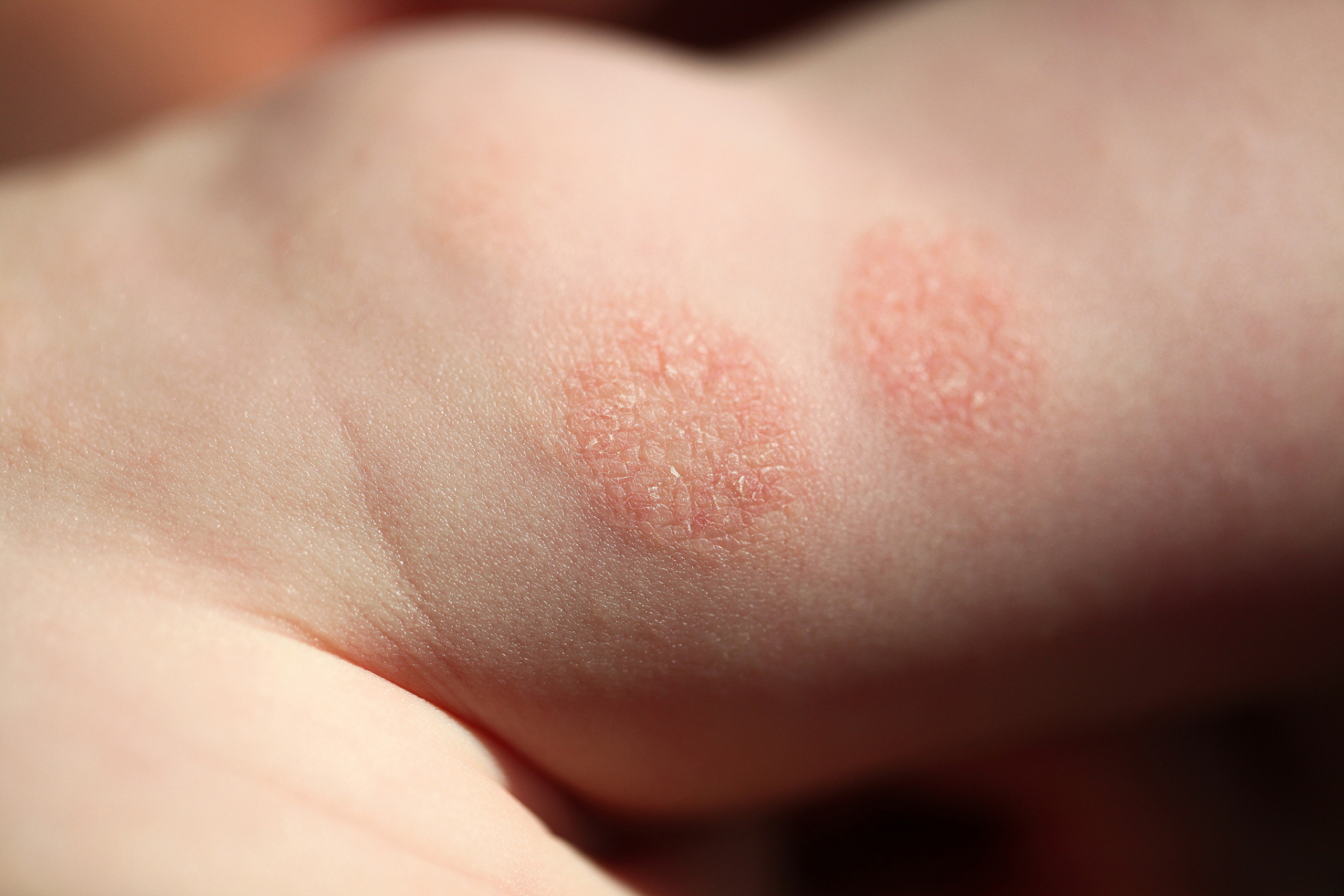 儿童湿疹,总是忍不住挠怎么办  儿童湿疹(也称为特应性皮炎)是一种