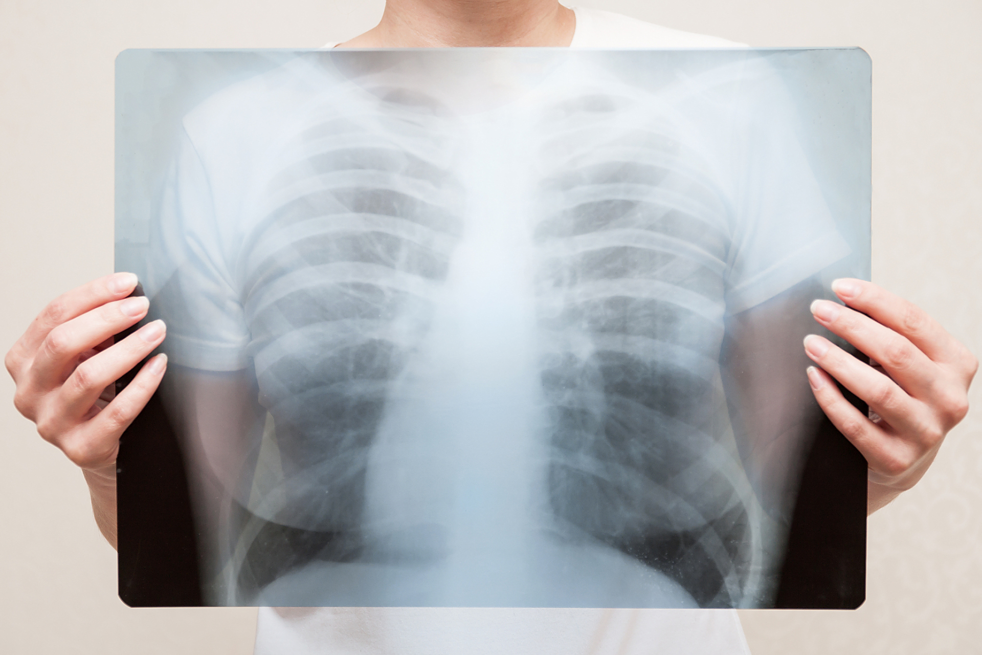 肋间神经因为各种原因(病毒,创伤等)出现的炎症反应,就是肋间神经 