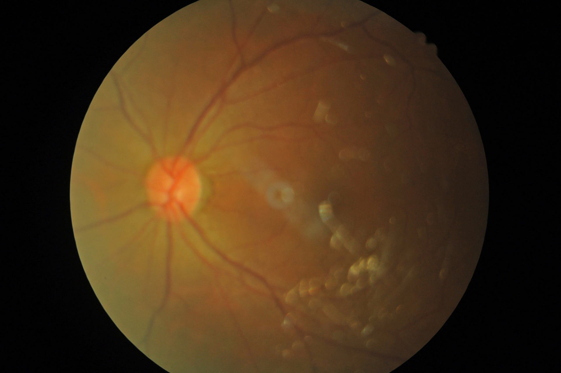 揭秘玻璃体混浊:眼内迷雾的真相 玻璃体混浊,是眼球内原本透明清澈的