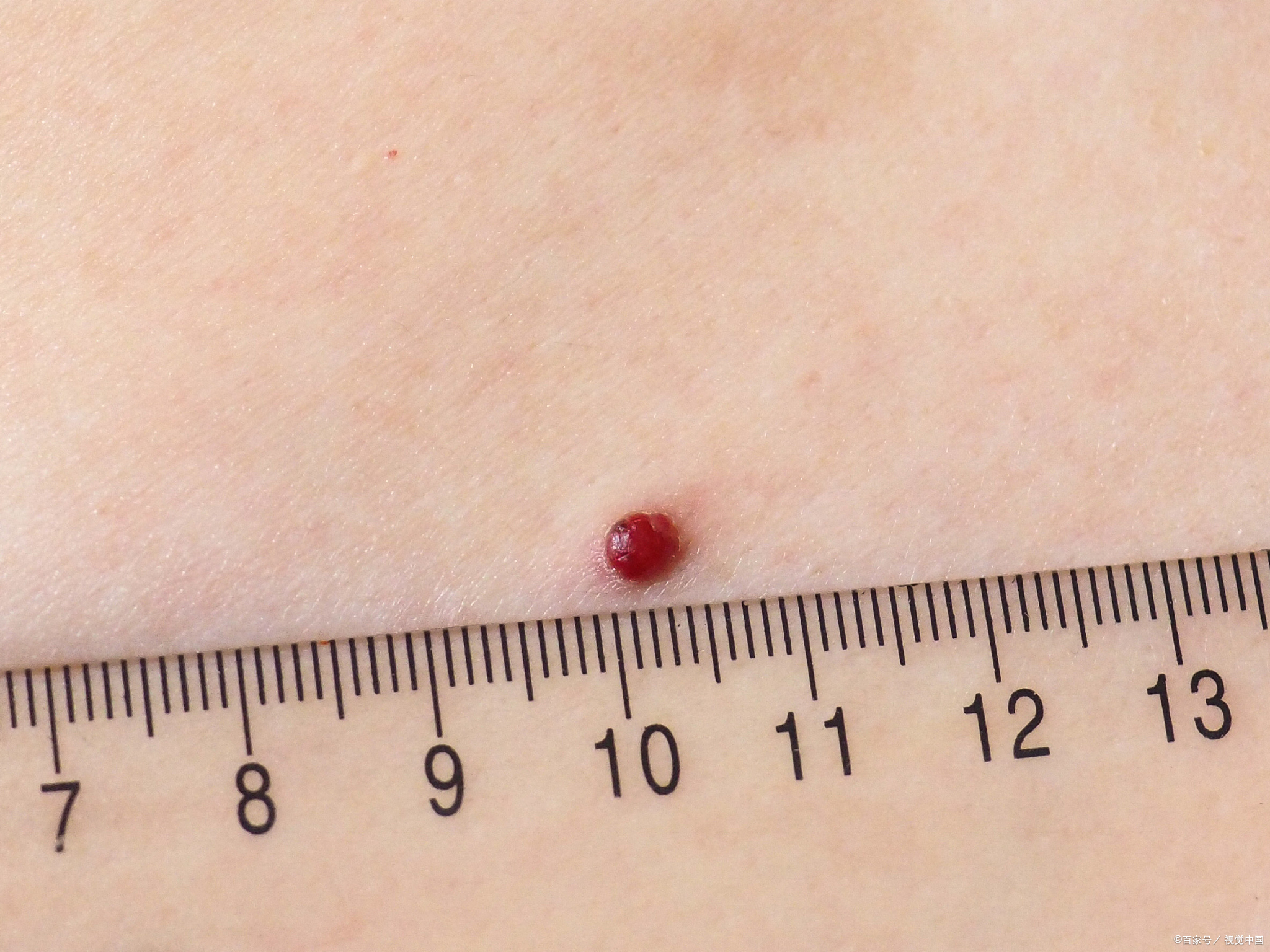 血管痣是婴儿常见的一种良性肿瘤,主要是由胚胎期血管网增生所形成