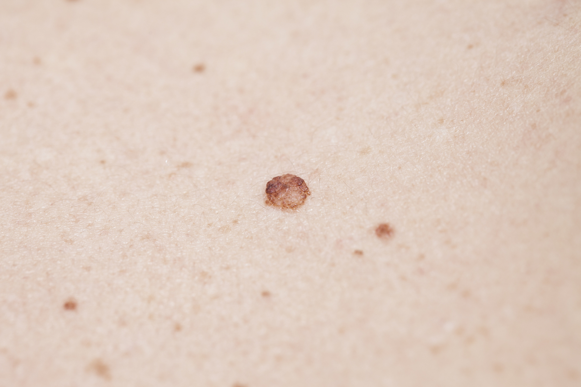 然而,如果能够及早发现黑色素瘤,就可以尽早采取相关措施,减少其影响.