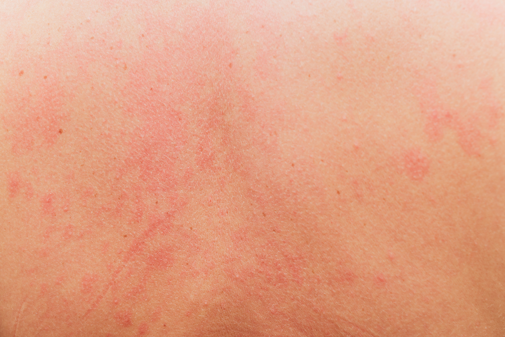 龟头冠状沟痒可能是过敏,龟头炎,生殖器疱疹等原因导致,需要对症用药