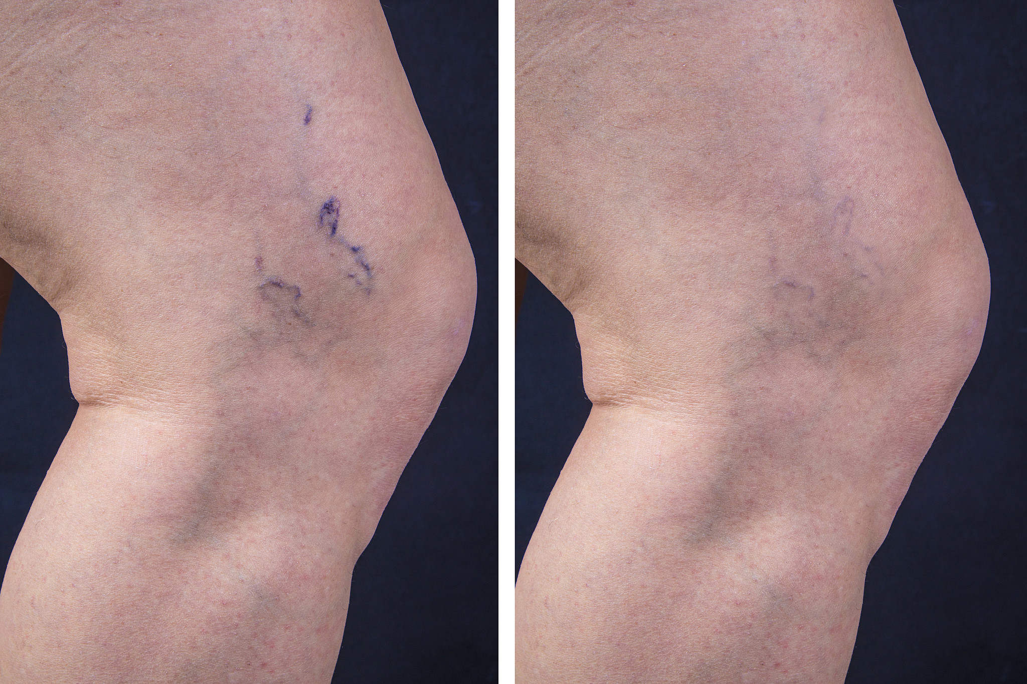 静脉曲张的自我疗法及护理