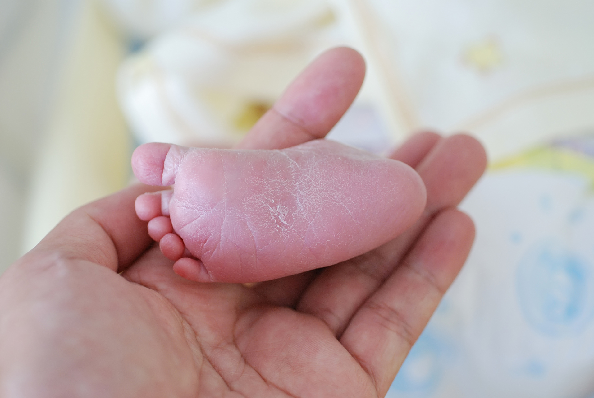 宝宝出现脚趾缝脱皮,瘙痒的,要注意可能是感染了脚气!