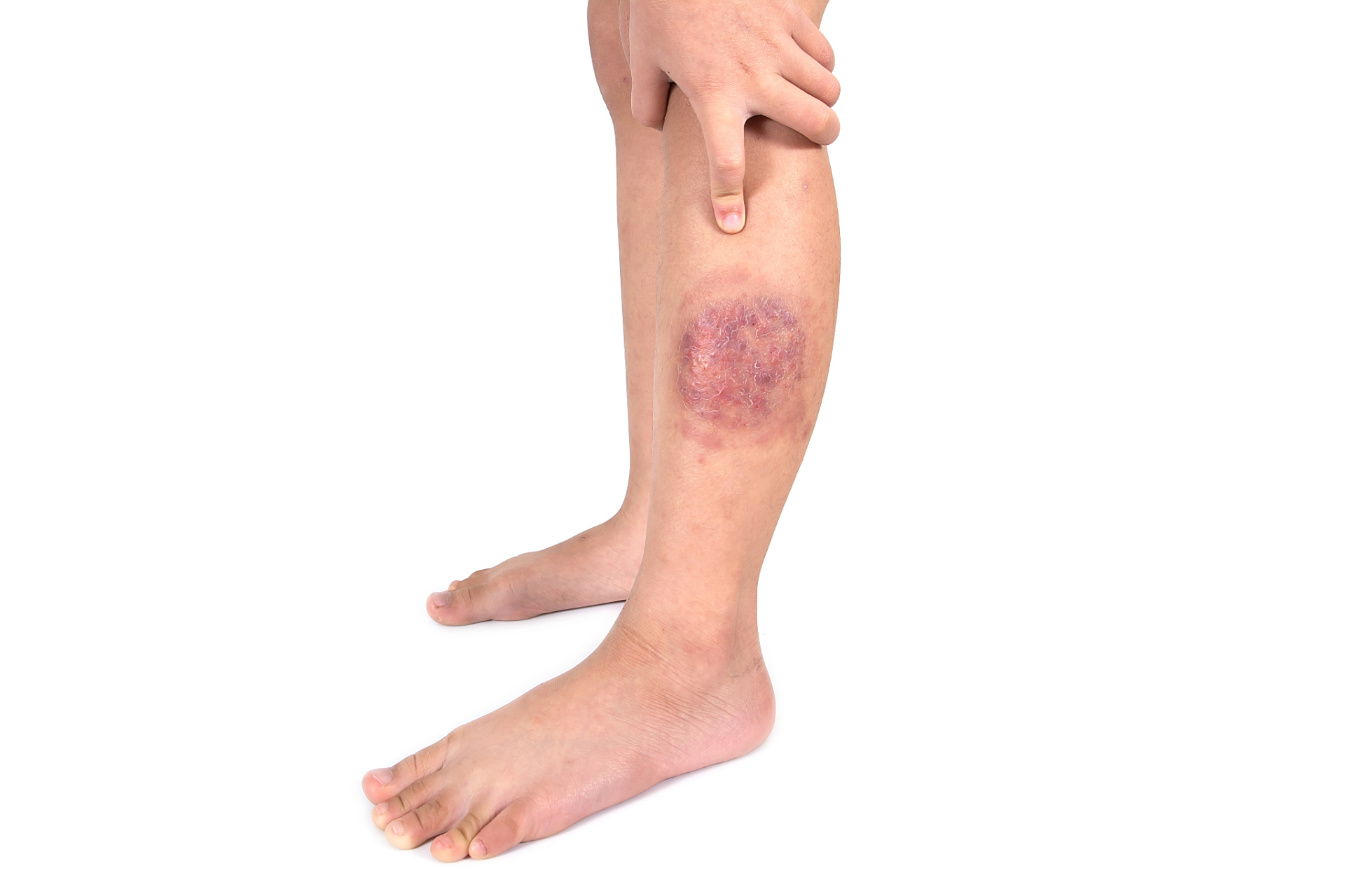 像这种圆形的红斑边界清晰,有脱皮还有点痒,注意了,不是湿疹而是体癣