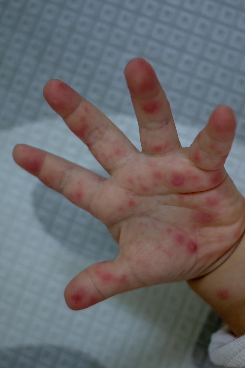 发烧是手足口病的常见症状之一,但并不是所有患儿会出现发烧