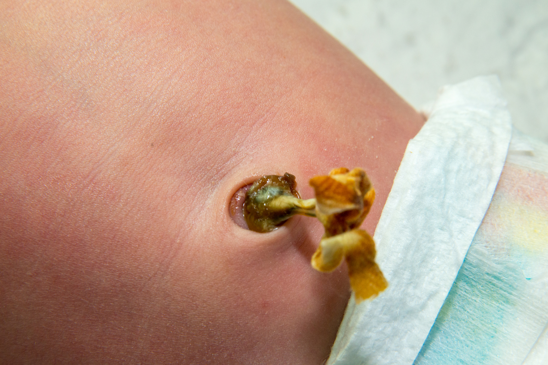 爸爸妈妈们在给脐带消毒的过程中,必须非常小心