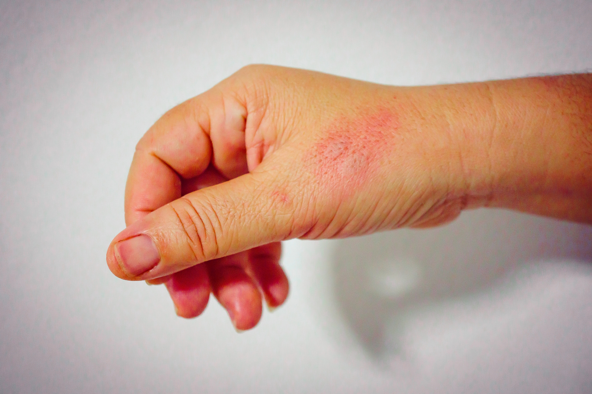 当皮肤受到热水等高温物质烫伤时,会造成皮肤组织损伤,甚至会引起组织