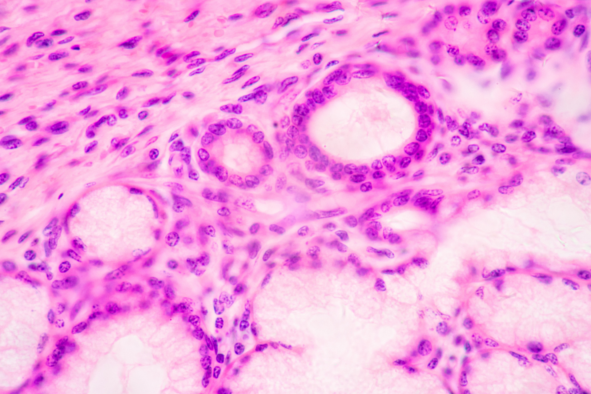 發現有較多的骨髓纖維化病友以及家屬對病情依舊存在認知不足,對於