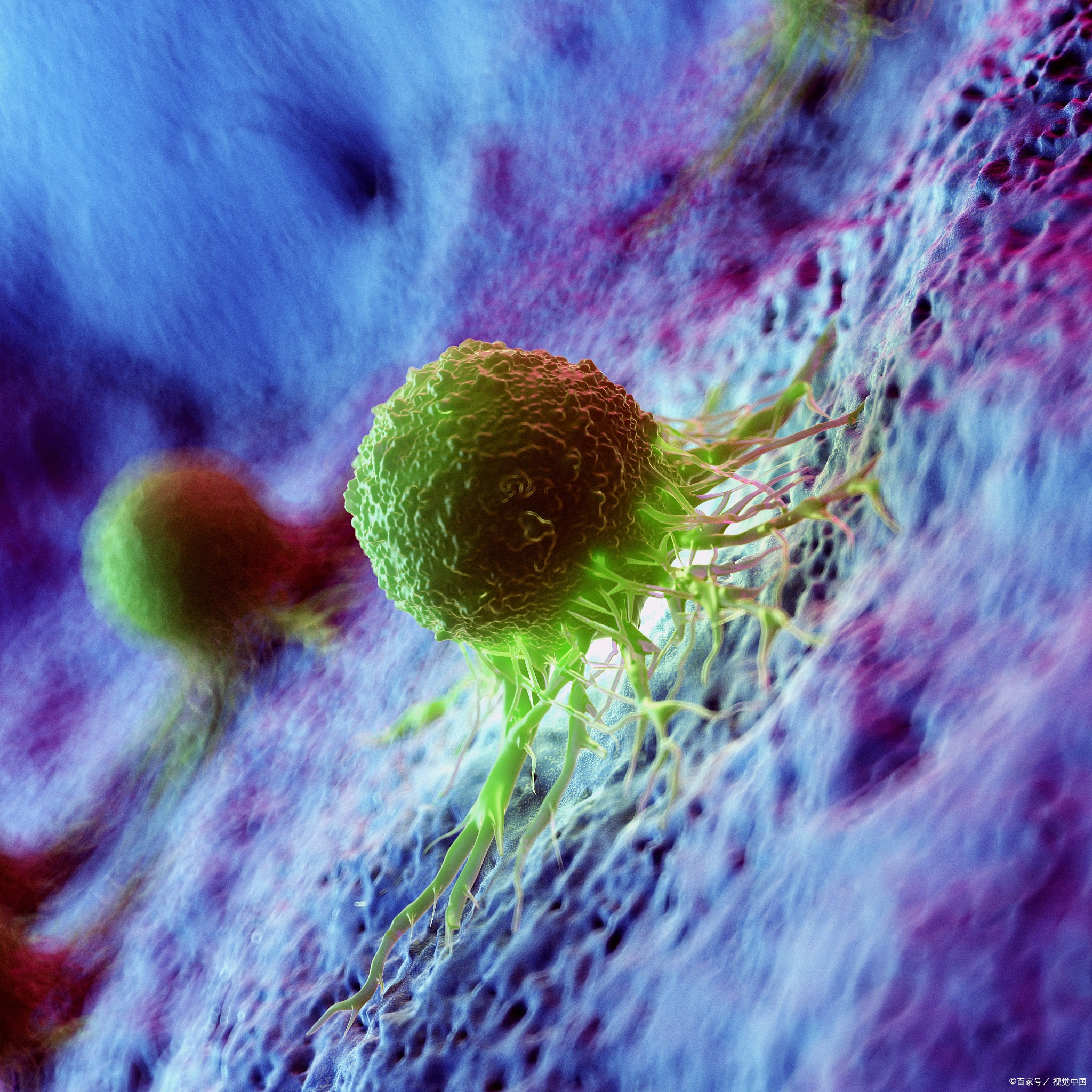 疾病客观缓解率达44til疗法成为晚期黑色素瘤宫颈癌克星