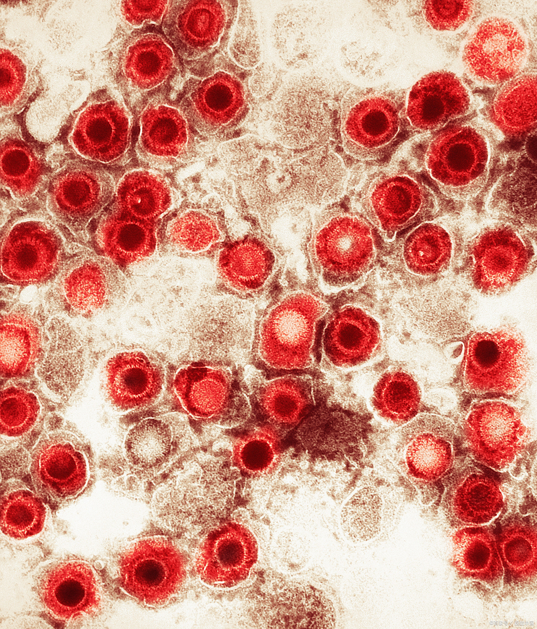 龟头疱疹来袭,是性病还是普通感染?