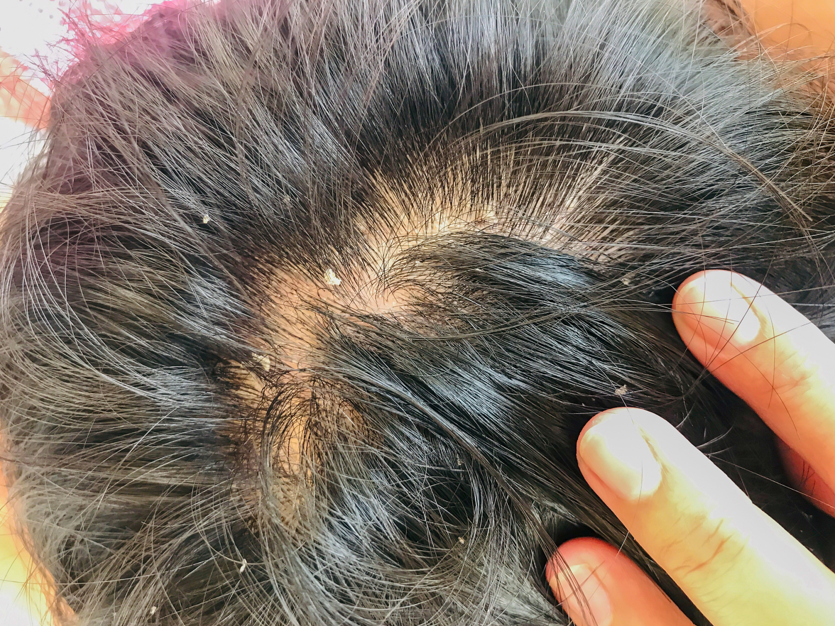 头部脂溢性皮炎非常困扰病人,由于个体的差异比较大,用药要全方面的