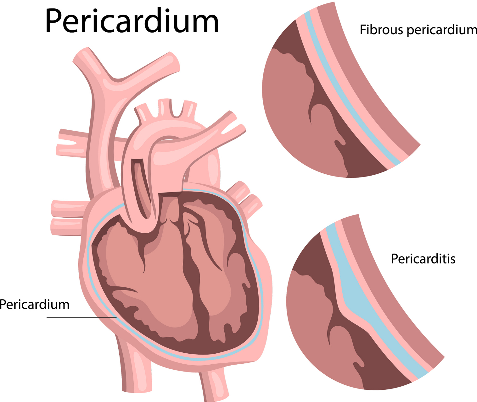 【什么是心包腔】  由浆膜性心包的脏层与壁层相
