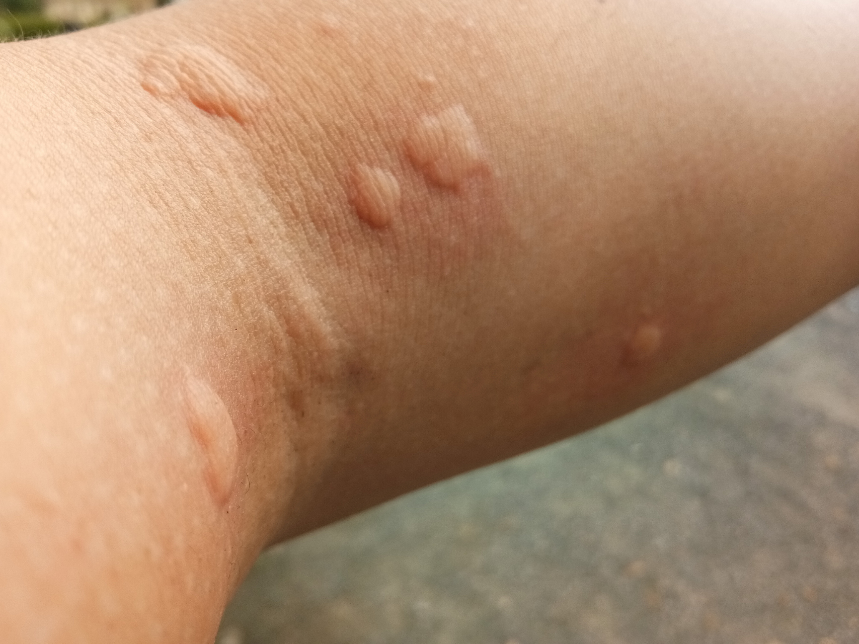 皮肤起疙瘩,越抓越多,怎么办好   皮肤起疙瘩,越抓越多,是一种常见的