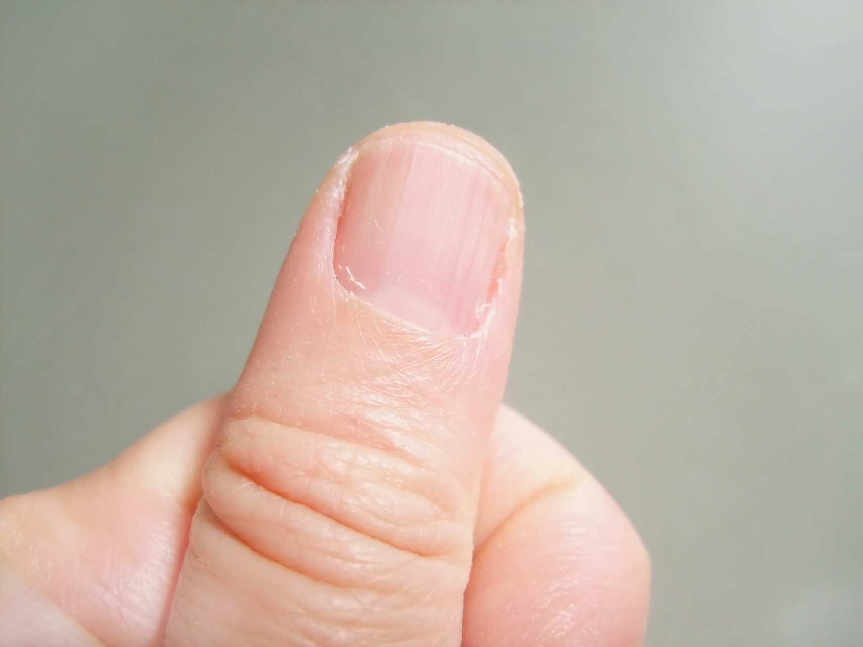 手指甲的竖纹隐藏着健康小秘密,原因揭晓 #健康经验笔记#  手指甲上的