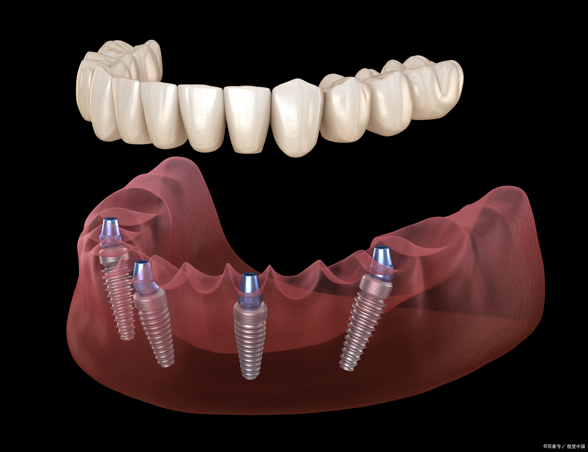 面对牙齿缺失的困扰,许多患者寄希望于种植牙,期待一劳永逸的解决