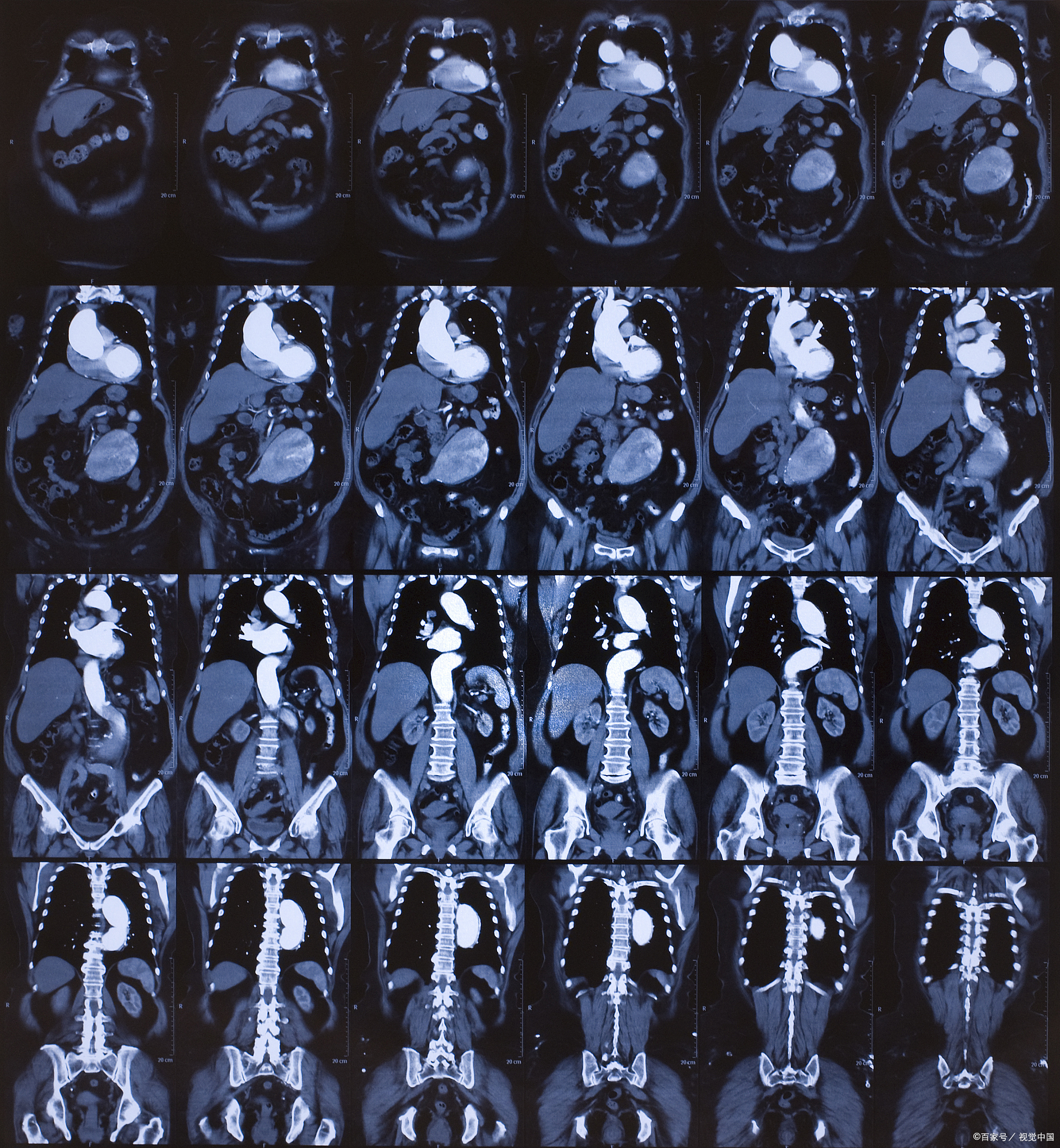 做冠状动脉造影对身体有什么坏处?