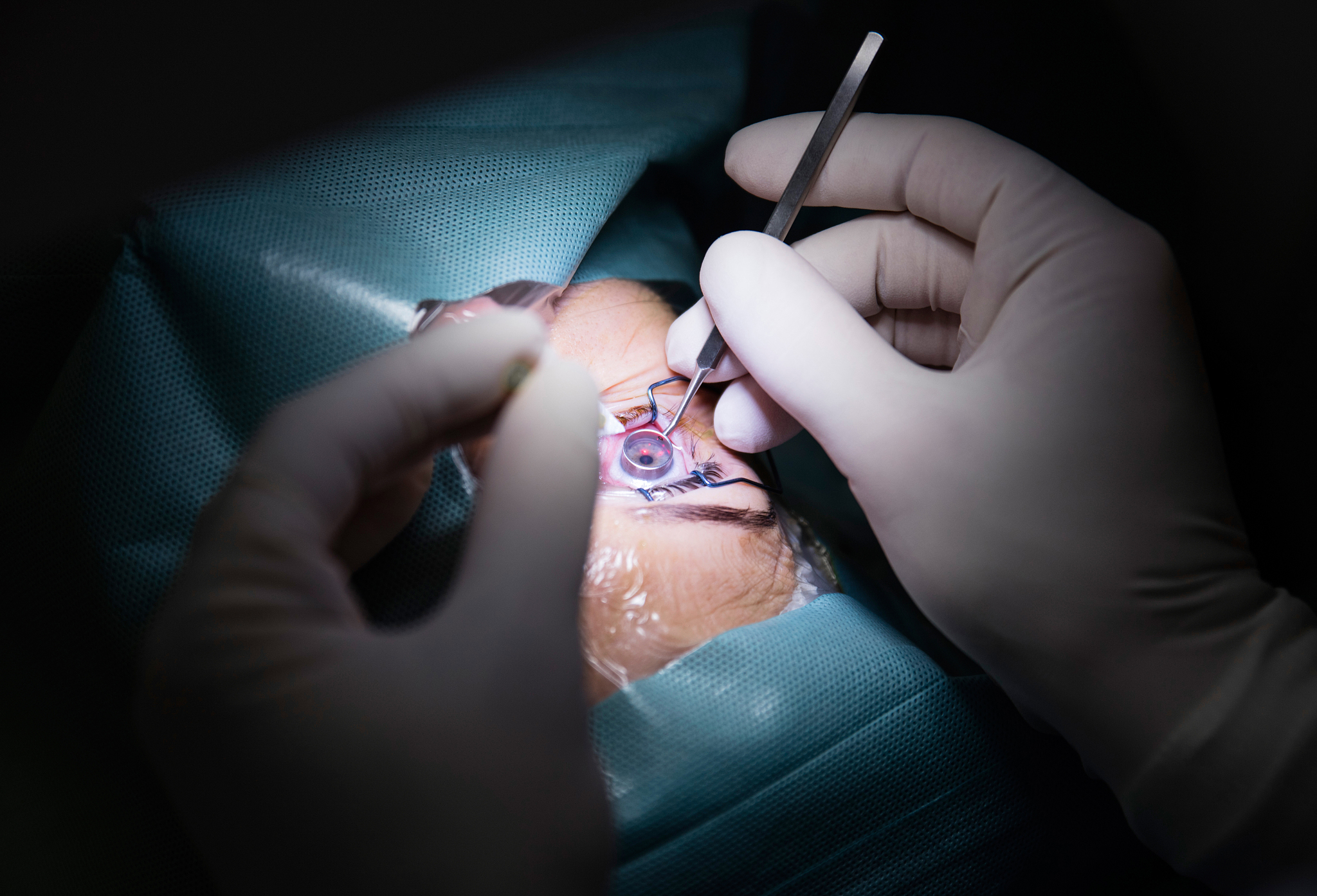 5钛板放到眼睛里睫状体冷冻术图片青光眼手术治疗图片大全眶下孔手 