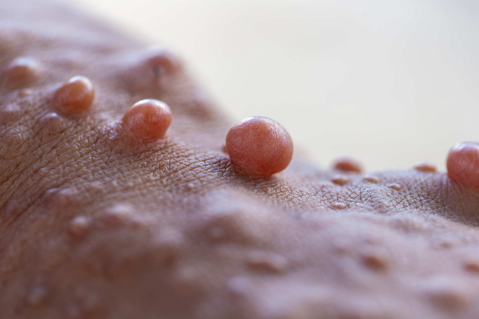 为什么很多人都害怕得神经纤维瘤?