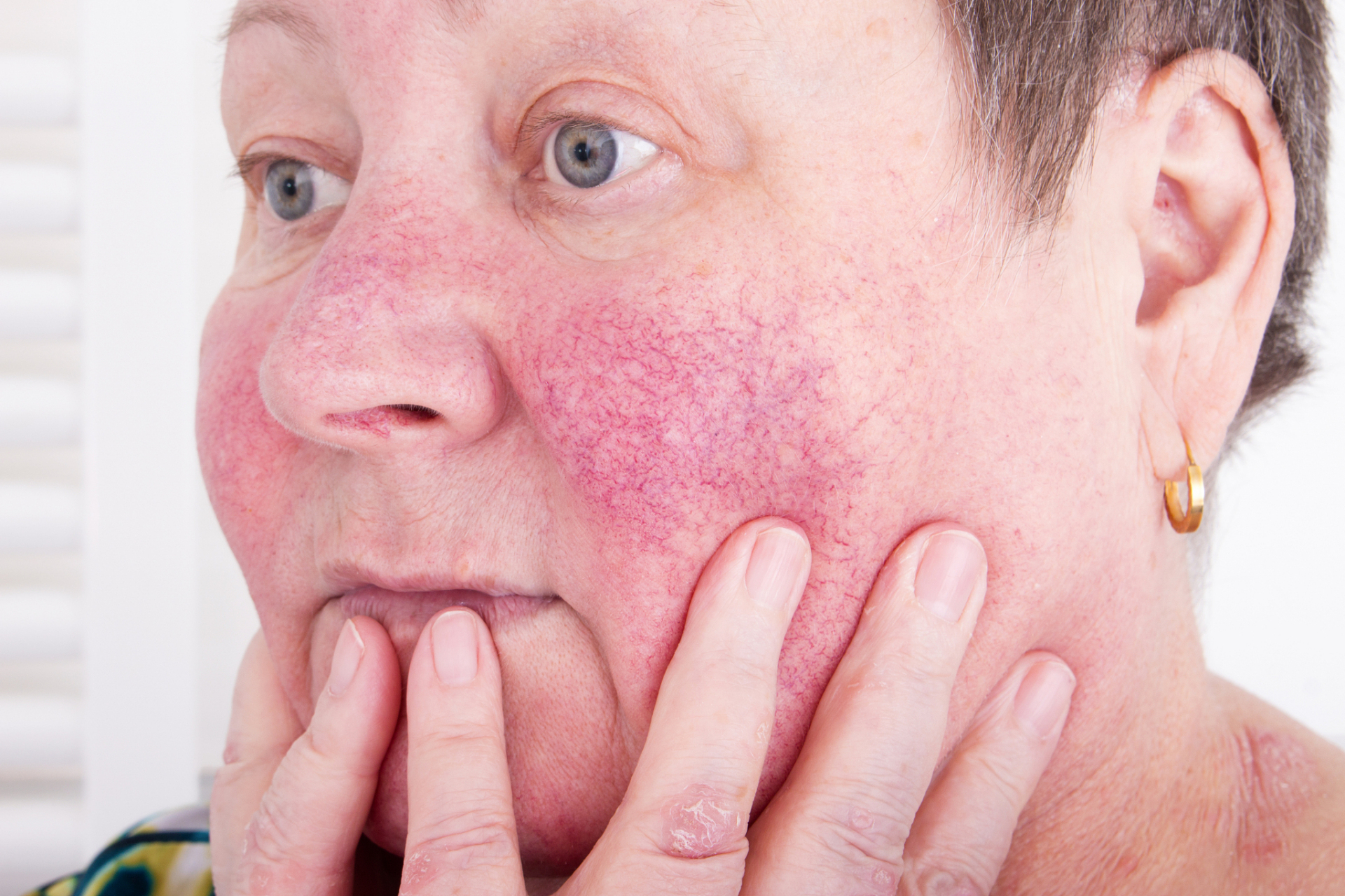 皮肤潮红可能是多种因素综合导致的,常见的有以下原因 1